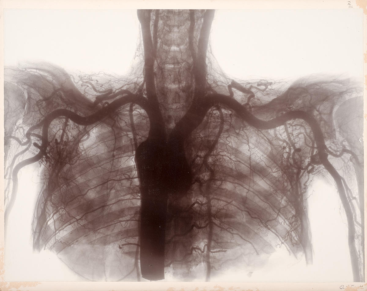 Stereo skiagram of the vessels of the upper part of thorax and shoulder