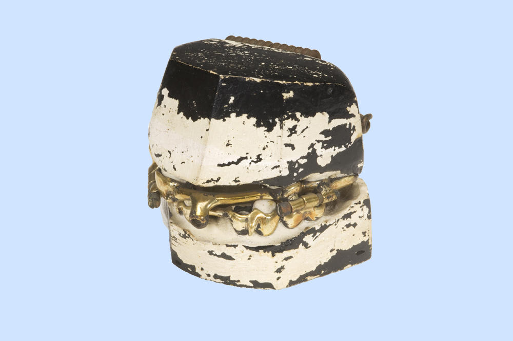 Cast metal upper and lower splints Faculty of Medicine, Dentistry and